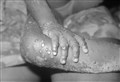 First case of Monkeypox has just been confirmed in Scotland