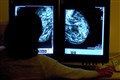NHS trusts routinely fail to hit urgent cancer target – data