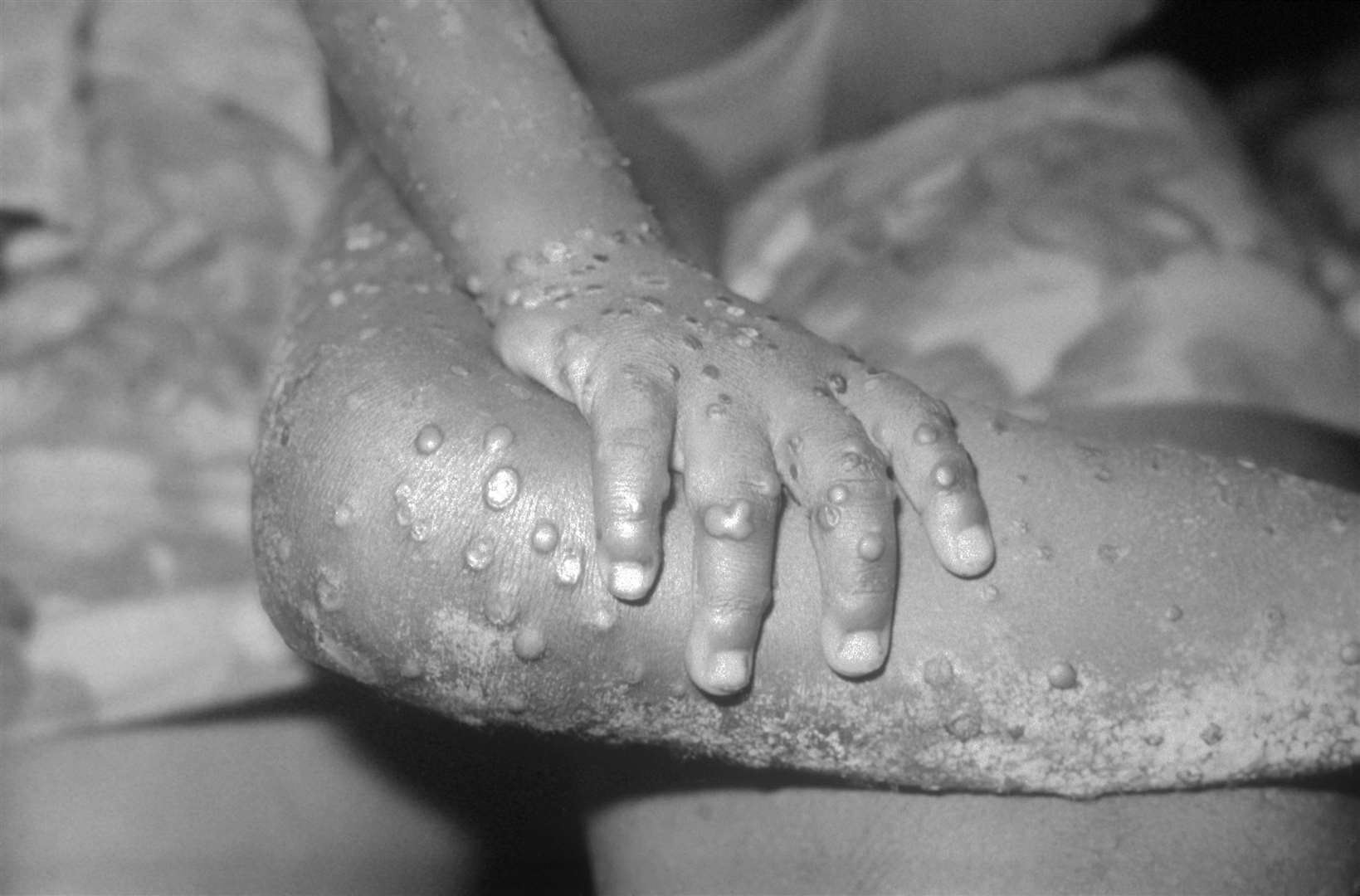 Close-up of monkeypox lesions on the arm and leg of a four year old girl in West Africa. Picture: CDC's Public Health Image Library.