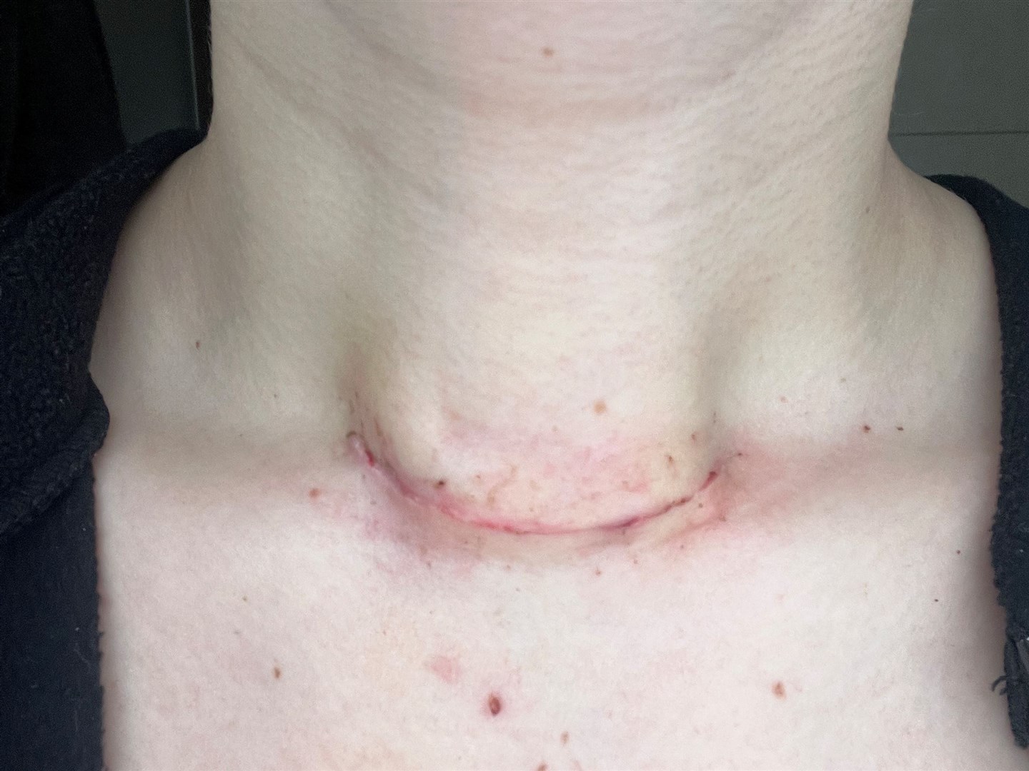 Megan Carr's neck a week after her second surgery