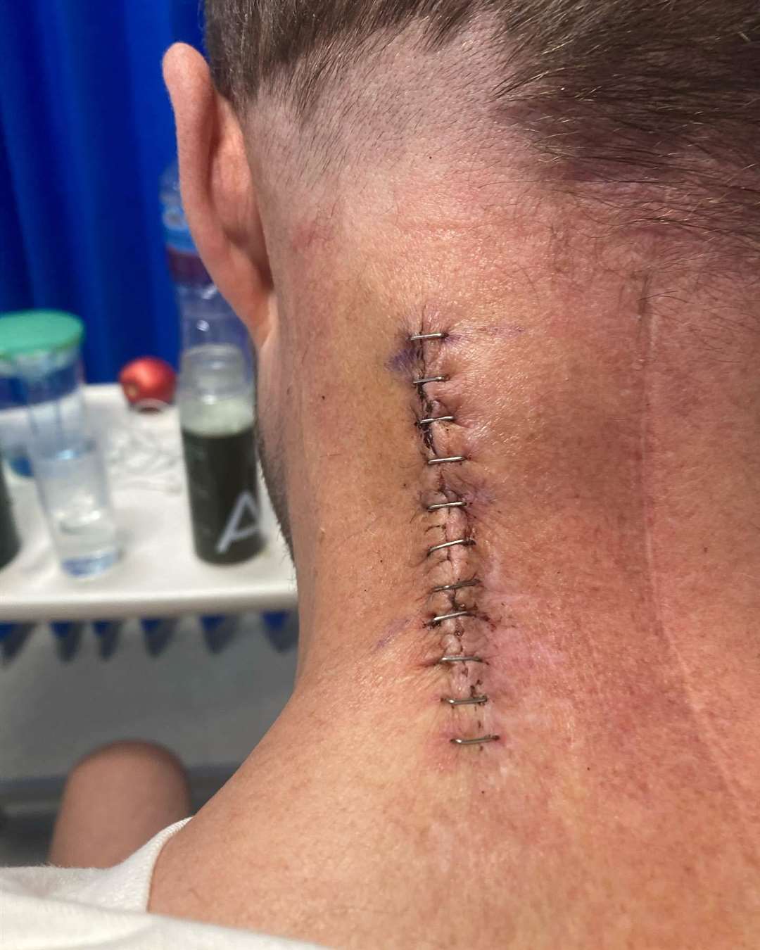 Neat job: Dave Smith after the latest surgery this week.
