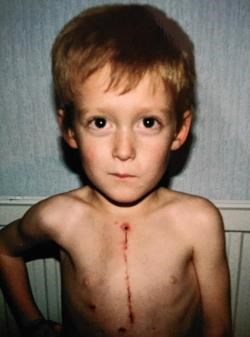 Kenny Wilson aged 5 with the operation scar he calls his 'zip'.