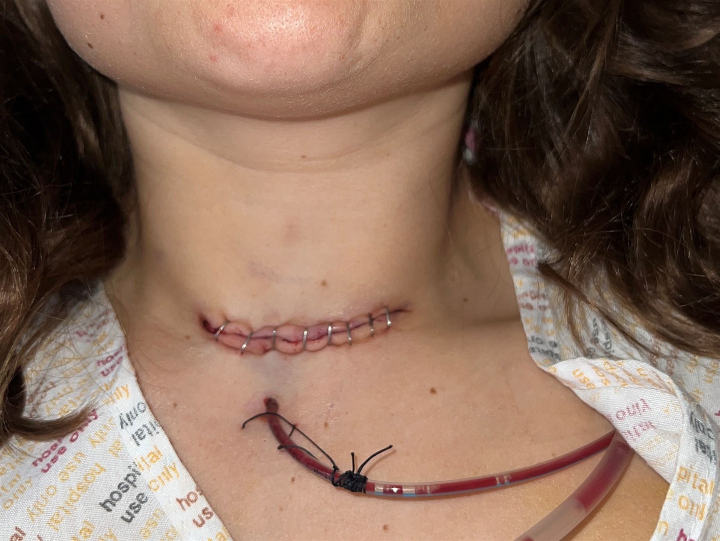 Megan Carr had to have a drain in her neck following her surgeries