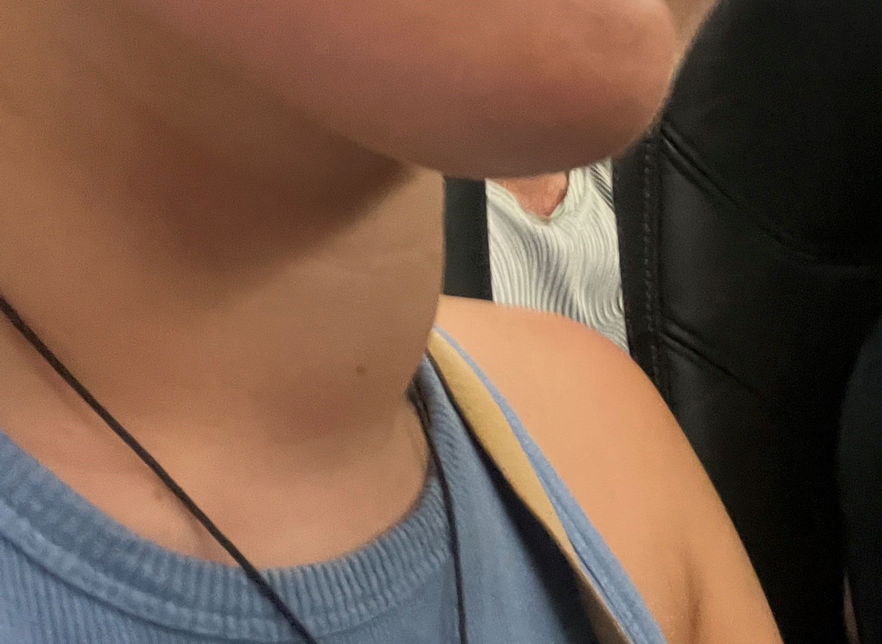 The lump on Megan Carr's throat was papillary thyroid cancer
